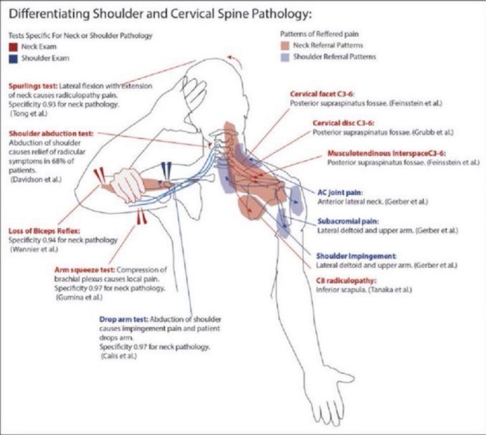 MoAImam's tweet photo. Pain referral patterns for the shoulder and examination to differentiate shoulder/neck pathology

#shoulder #neck #pain

https://t.co/RNFHbyCSZ4 https://t.co/BBozWWUB2u