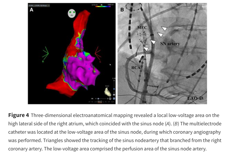 European Society of Cardiology Journals (@esc_journals) on Twitter photo A non-idiopathic case of sick sinus syndrome ow.ly/zlJJ50VSnfE
#EHJCaseReports <a href="/Phiso_de/">Philipp Sommer</a> <a href="/TJ_Yeo/">Tee Joo YEO</a> <a href="/aayshacader/">Aaysha Cader</a> <a href="/BoldiKovacsMD/">Boldizsar Kovacs</a> <a href="/KardiologieHH/">Erik Rafflenbeul</a> <a href="/ANazmiCalik/">A.Nazmi Calik</a> <a href="/O_Azizy_MD/">Obayda Azizy</a> <a href="/saramoscatelli7/">Sara Moscatelli</a> <a href="/EHJCREiC/">EHJCaseReports Editor-in-Chief</a> #CardioX #EPeeps A non-idiopathic case of sick sinus syndrome ow.ly/zlJJ50VSnfE
#EHJCaseReports <a href="/Phiso_de/">Philipp Sommer</a> <a href="/TJ_Yeo/">Tee Joo YEO</a> <a href="/aayshacader/">Aaysha Cader</a> <a href="/BoldiKovacsMD/">Boldizsar Kovacs</a> <a href="/KardiologieHH/">Erik Rafflenbeul</a> <a href="/ANazmiCalik/">A.Nazmi Calik</a> <a href="/O_Azizy_MD/">Obayda Azizy</a> <a href="/saramoscatelli7/">Sara Moscatelli</a> <a href="/EHJCREiC/">EHJCaseReports Editor-in-Chief</a> #CardioX #EPeeps