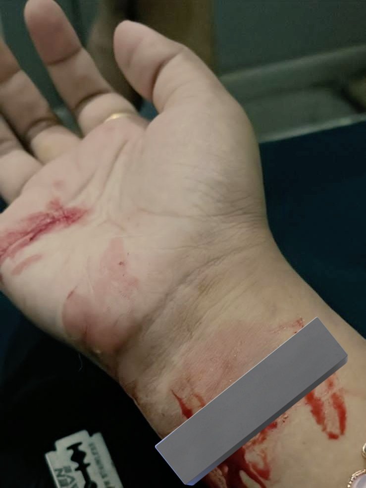 ISSUED IN PUBLIC INTEREST: BIGGEST RED FLAG 

Whether man or woman, if you see multiple cuts on wrist of a person, consider it as the biggest red flag 

I have counselled several men who have sent me images like one below. Threats of false cases along with threats of suicide
