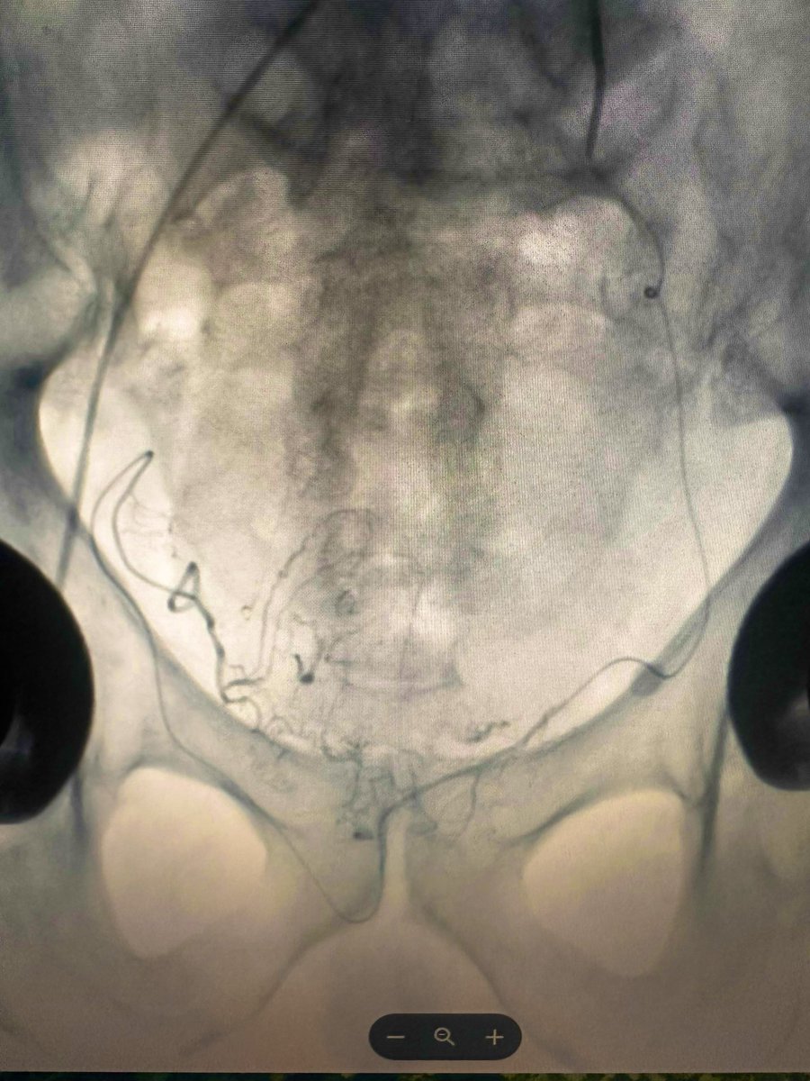 Don Garbett (@dongarbettmd) on Twitter photo #PAE Advanced Prostate embolization. Sometimes you get both sides in one ☝️. <a href="/IRcenters/">IRcenters</a> <a href="/SIRRFS/">SIR RFS</a> <a href="/SIRspecialists/">Society of Interventional Radiology</a> <a href="/UrologyAustin/">Urology Austin</a> #PAE Advanced Prostate embolization. Sometimes you get both sides in one ☝️. <a href="/IRcenters/">IRcenters</a> <a href="/SIRRFS/">SIR RFS</a> <a href="/SIRspecialists/">Society of Interventional Radiology</a> <a href="/UrologyAustin/">Urology Austin</a>