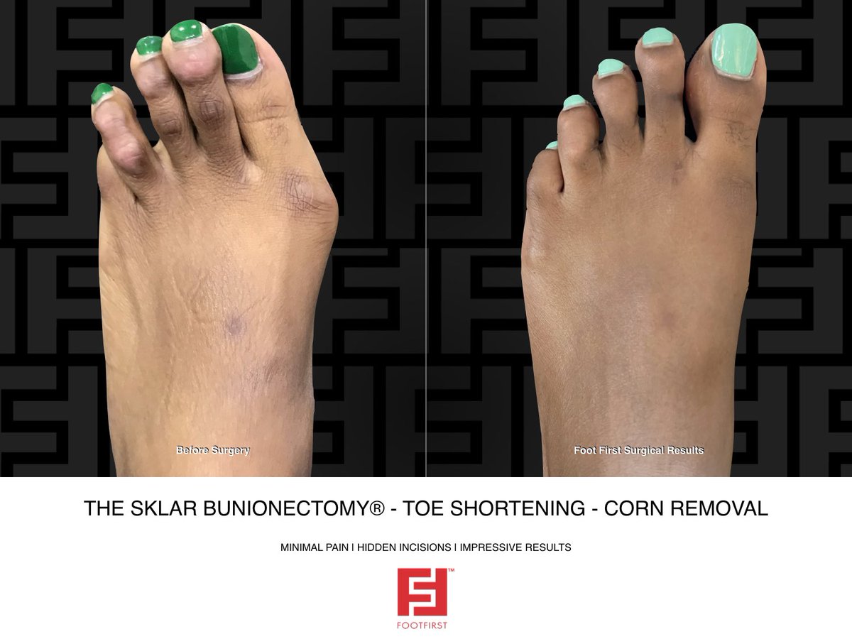 foot1st's tweet photo. Bunion gone and corns are too, Shorter toes that look brand new! No more pain, just happy feet — Now every step feels light and sweet!” 🤩✨
#BunionBeGone #CornNoMore https://t.co/cSGacZUQqF