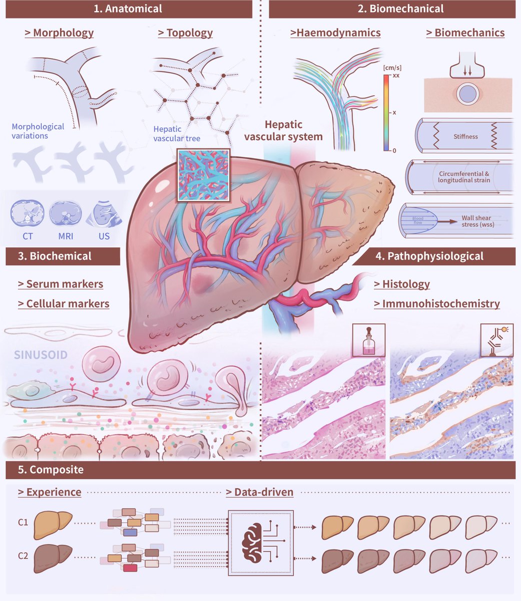 #GUTImage from the #RecentAdvancesInClinicalPractice paper by Wang et al entitled

"Vasomics of the liver" via bit.ly/3Fkske5

#Vasomics #CLD