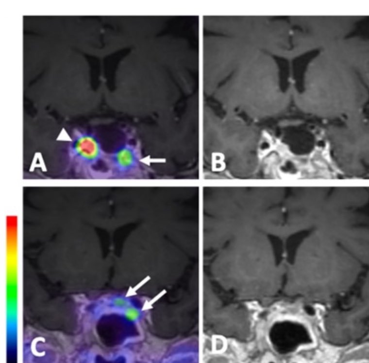 jana_ivanidze's tweet image. Tuesday 11 / Franklin Hall 9 

Sean Kim @WCMRadRes will present on #DOTATATE #PET in #pitNET 

#ASNR25