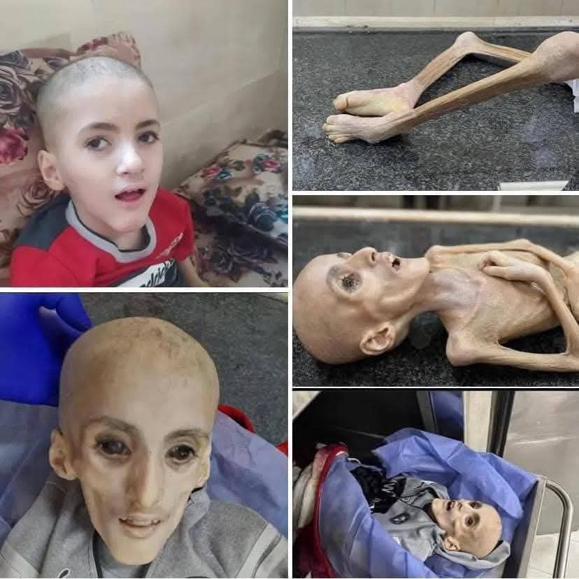 Can you believe this? This child, Yazan, passed away in Gaza a few days ago at the age of 10 — without food or medicine. In his final days, he weighed only 5 kilograms...

We will never, ever forget.

#Gaza
#Palestine