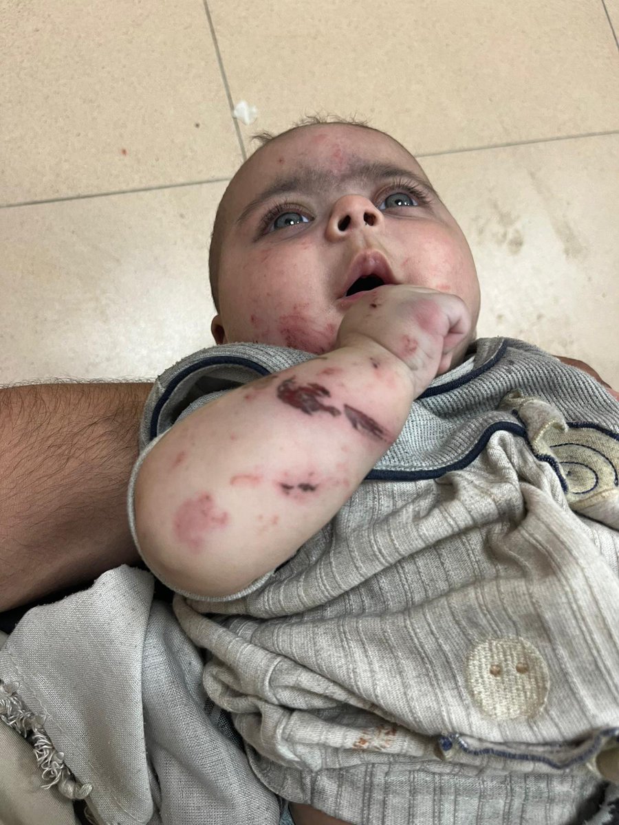 AAlhaddad00's tweet image. 🇵🇸😭🍉Help us, save us
We need a tent and treatment urgently.
chuffed.org/project/128475…
😭🍉We were bombed yesterday and my wife and children were injured.
Help us and save our children😭🍉🇵🇸