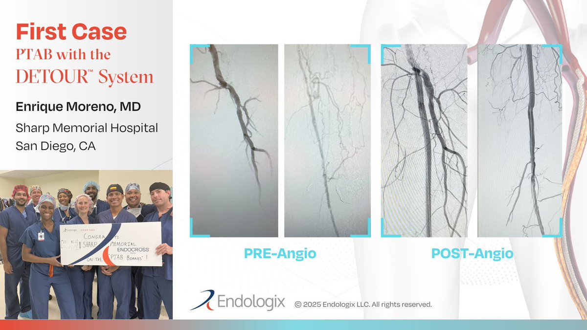 We are happy to announce that the #DETOURSystem has arrived at Sharp Memorial Hospital in San Diego, thanks to Dr. Enrique Moreno and team. Congratulations on your first #PTAB case and for restoring blood flow to the leg of a patient that faced high risk of complications. 
Learn
