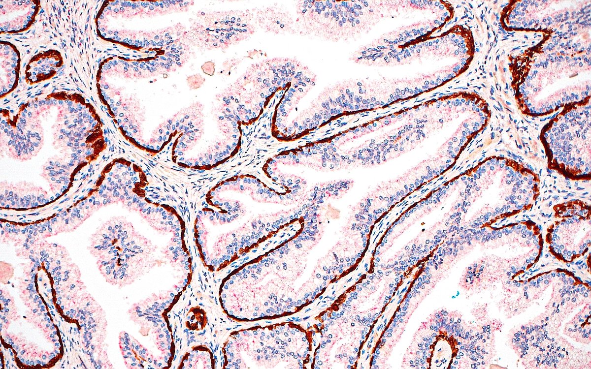🔬 Basal Cells in Benign Prostate Glands ~ PIN4 immunohistochemical stain ~ #GUpath #Pathology #Histology #PathArt