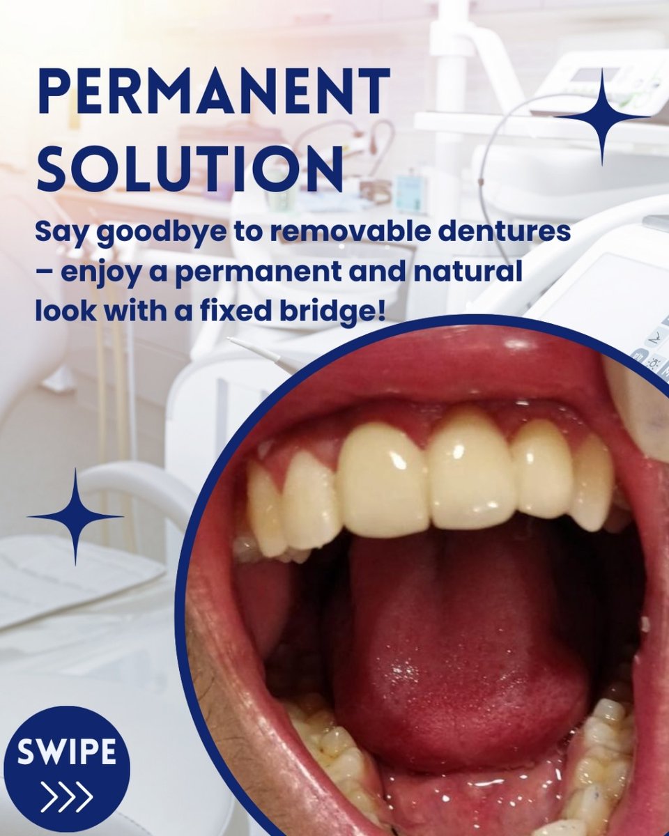 priyavermadent1's tweet image. Accidents may cause tooth loss, but don’t worry—Smile Zone Clinic has the perfect solution! Restore your smile with a fixed bridge for a natural, permanent look. 😁✨

Website: dentalclinicinwhitefield.com
☎️ +91 99006-00868

#SmileZoneClinic #ToothRestoration #FixedBridge