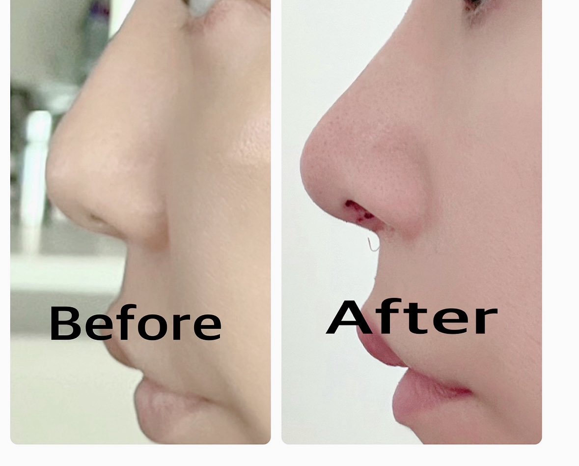 1年前ドクター美でノーズビームしました。
術後3日目
ダウンタイムも凄く軽かったです。