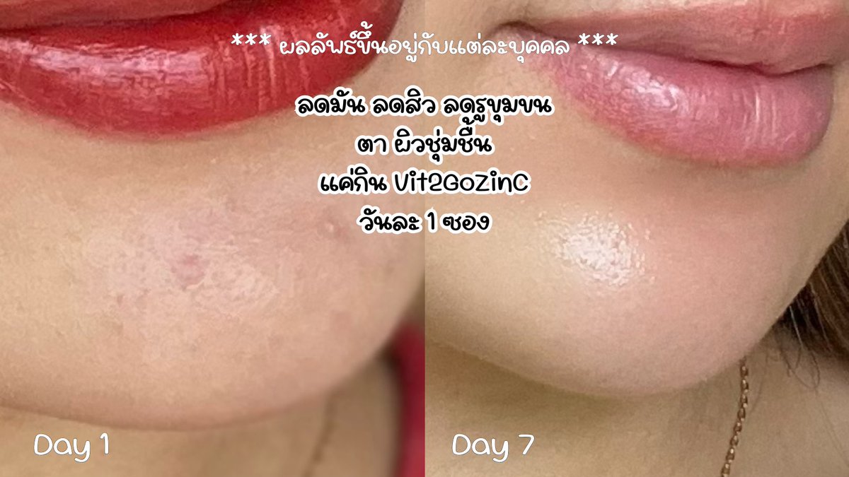 yanaarisamd's tweet photo. ช่วงนี้เห่อวิตามินลดสิว Vit2Go ZinC มากก นางดูเทรนดี้เหมาะกับวัยรุ่นวัยเราสุดๆ สูตรนี้สิวยุบแห้งไว ผิวมันน้อยลง รูขุมขนกระชับขึ้นด้วยงับ มี 2 สูตร Girl💜 Boy 💚ทานง่ายมาก พกพาสะดวก ซองนึงมี 2 แคปซูล
พิกัด 7-11 ราคาแค่หลักสิบบ ซองละ 15.- ไปลองกัน
#Vit2Go #Vit2GoZinC #Vit2GoHeyboy #Vit2goHeyGirl #Vit2GoวิตามินลดสิวสูตรGenZ #Handyherb