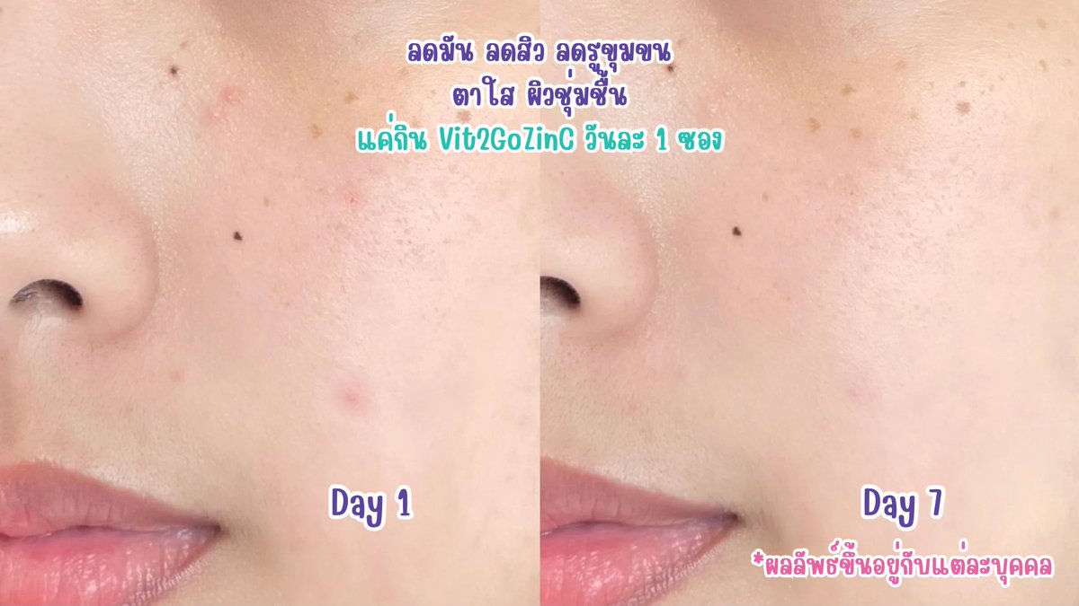 mypluems's tweet photo. ใครผิวมัน สิวบุก ผิวพังต้องดูทางนี้ด่วนนน เจอวิตามินตัวเด็ดที่ช่วยจริงแบบไม่จกตา #Vit2GoZinC เค้าออกสูตรแยกชายหญิง แก้ปัญหาตรงจุดมากเว่อ แคปซูลกินง่าย ราคาน่ารักแค่ 15 บาท ซองเดียวคือเห็นผล ป้ายยามากเพราะชอบจริง พิกัด 7-11💜
#Vit2Go #Vit2GoZinC #Vit2GoHeyboy #Vit2goHeyGirl #Vit2GoวิตามินลดสิวสูตรGenZ #Handyherb