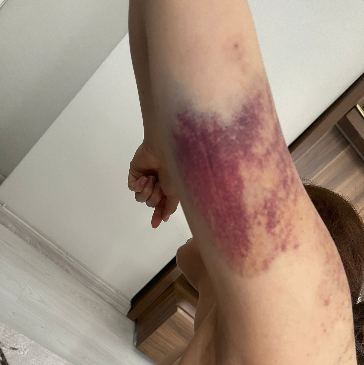 MamedogluMedine's tweet photo. Skandal bir karar! 

Seda Eker, boşanma aşamasında olduğu Hebun Eker ve ailesi tarafından darp edilip, ölümle tehdit edildi. Uzaklaştırma ve ev hapsi kararı ile serbest bırakılan Hebun Eker’in ev hapsi kararı Seda Eker’in yaşadığı eve verildi. 

Jinnews’te ki haberim. 

https://t.co/ezugVb53r6