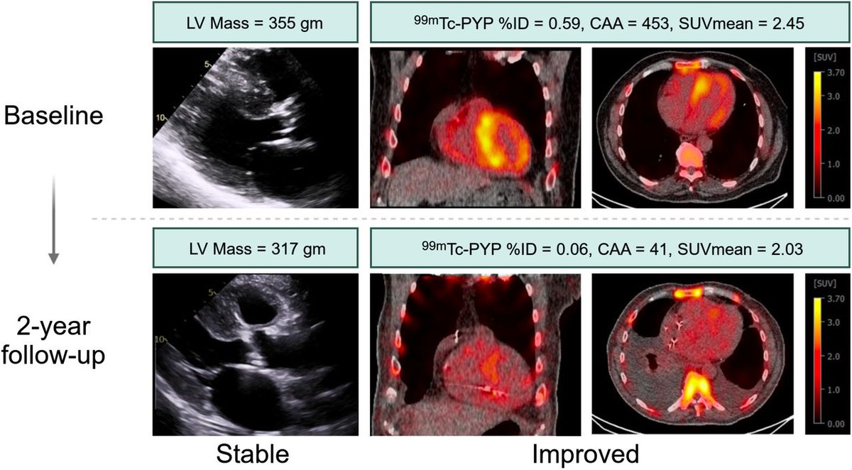 JNM (@journalofnucmed) on Twitter photo From stabilization to depletion: Molecular imaging to measure therapeutic response in ATTR-CA. ow.ly/s9Zk50VuM4s
#MolecularImaging #NuclearMedicine #Amyloidosis <a href="/DorbalaSharmila/">Sharmila Dorbala</a> <a href="/SVijayakumarMD/">Shilpa Vijayakumar</a> From stabilization to depletion: Molecular imaging to measure therapeutic response in ATTR-CA. ow.ly/s9Zk50VuM4s
#MolecularImaging #NuclearMedicine #Amyloidosis <a href="/DorbalaSharmila/">Sharmila Dorbala</a> <a href="/SVijayakumarMD/">Shilpa Vijayakumar</a>