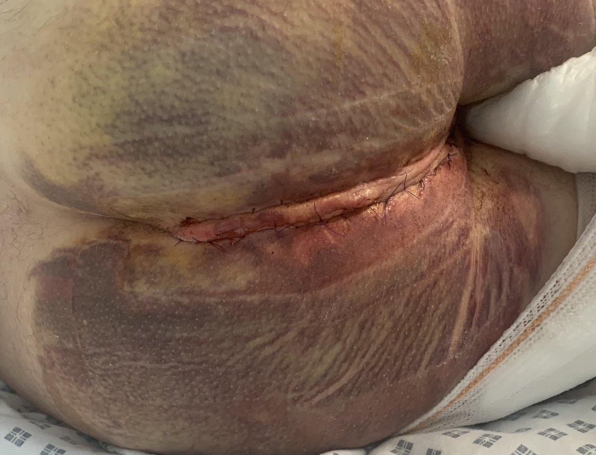 Today is World IBD day <a href="/CrohnsColitisUK/">Crohn's & Colitis UK</a> 

For me it’s a day of reflection on how Inflammatory bowel disease has changed my life over the past 10 years. 

Tried all the medications, didn’t work

Weeks in hospital 

6 x operations 

Stoma 

Removal of anus 

#CourageLooksLikeThis