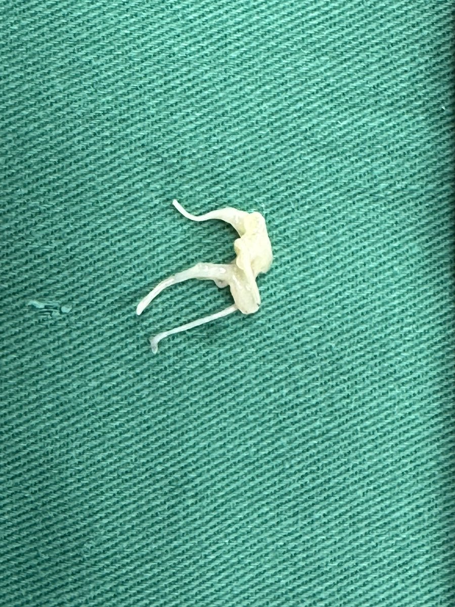 DrYongCui's tweet photo. I have been afraid to use Dr. Daniel Swistel’s recently published technique of shortening the mitral leaflet (Pic 1-3) in HOCM patients. But I got a suitable young gentleman today and eventually I realized this is the best solution to his redundant  A2 segment. So in this MESM procedure, a small piece of A2 was resected and the final result is superb!(Pic 4-7)