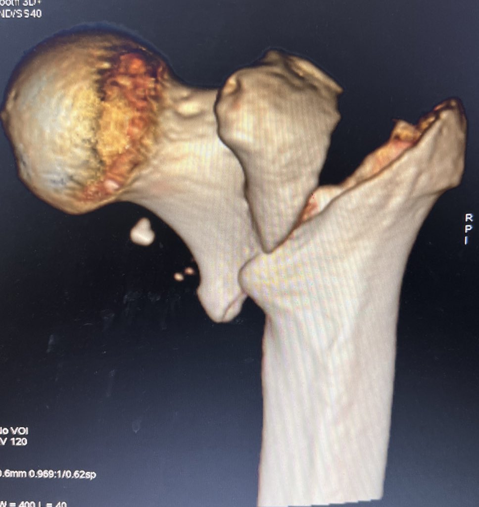 Bipin Theruvil FRCS (T&O),FRCS (Ed&Glasg),MS AIIMS tweet media