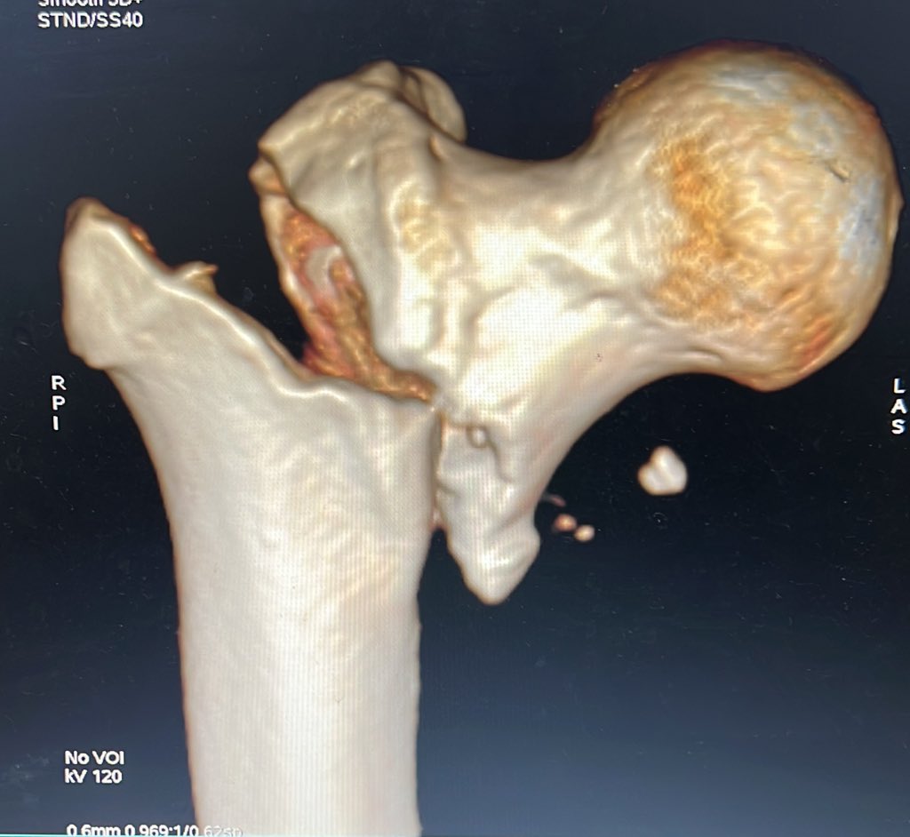 Bipin Theruvil FRCS (T&O),FRCS (Ed&Glasg),MS AIIMS tweet media