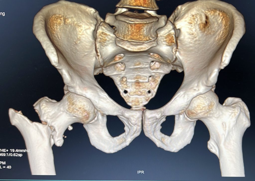 Bipin Theruvil FRCS (T&O),FRCS (Ed&Glasg),MS AIIMS tweet media