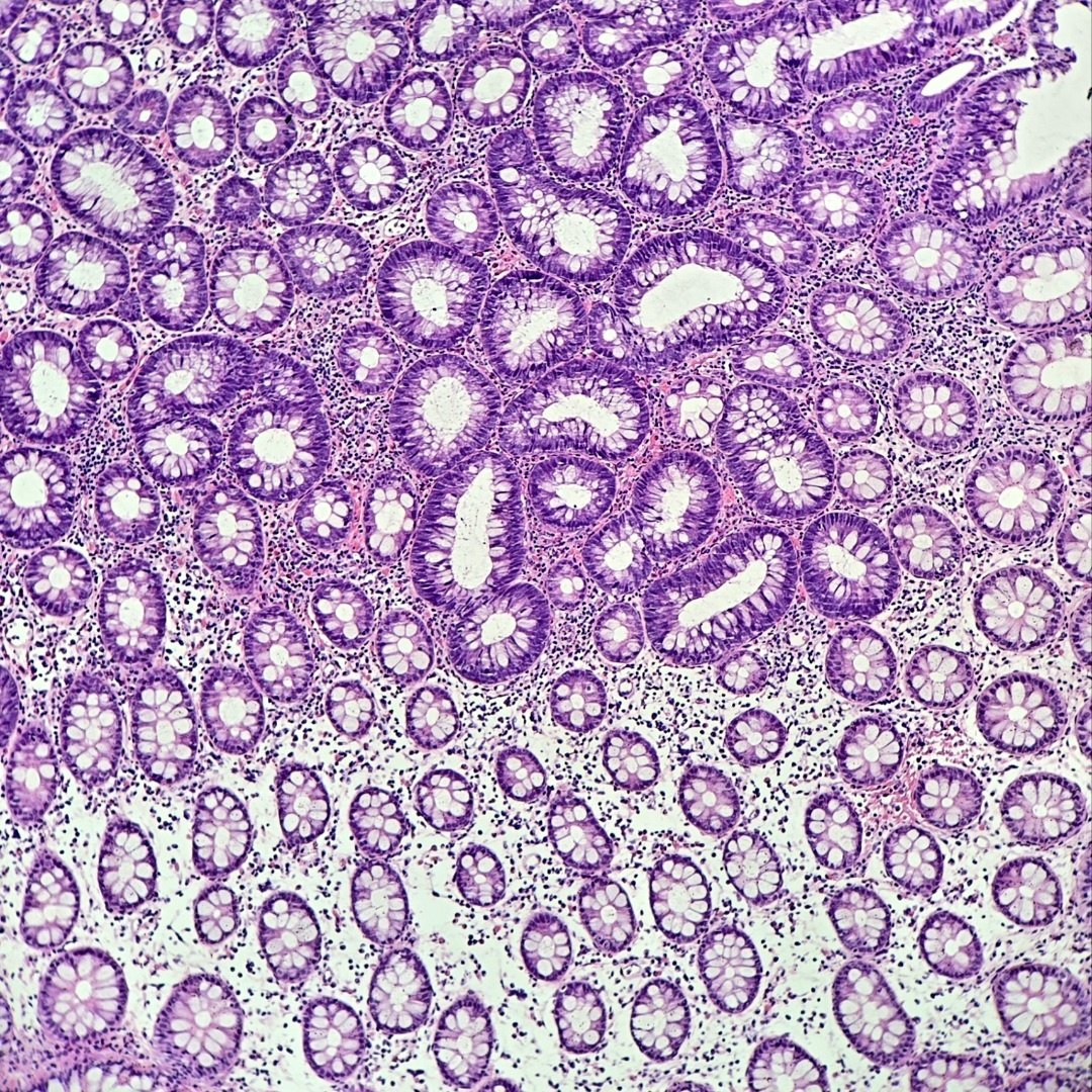 Behnas Malek F.Z (@malakbehnas) on Twitter photo 🔬Spotted: a tubular adenoma with low-grade dysplasia just chilling next to perfectly normal colonic mucosa.
#beautyOfPathology #GIpath 🔬Spotted: a tubular adenoma with low-grade dysplasia just chilling next to perfectly normal colonic mucosa.
#beautyOfPathology #GIpath