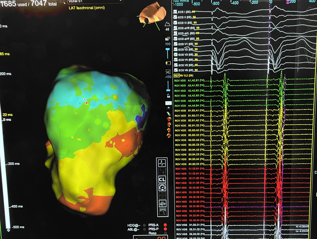 ivroca's tweet photo. Thanks @JosefKautzner @Petr_Peichl @P_Stojadinovic and all Prague team to host me in the #PragueRhythm2025.@hospitalclinic I enjoyed doing a #S3 VT case in your lab! Amazing team. Thanks @JuditMasC_ and @rosa for support. Learing always fron @shivkumarmd and @DrFerminGarcia https://t.co/uFrrouiezf