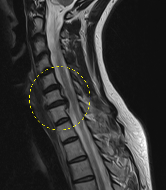 TDekkersPhysio's tweet photo. ‼️Do NOT perform cervical manipulation if your patient has a scan like this‼️👇

This patient was being manipulated/adjusted every 2 weeks for months for neck pain....

The scan shows a large C6/7 disc protrusion with severe right foraminal stenosis. There is a lesser disc protrusion also at C5/6.

For the record Ive done extensive manual therapy training, including manips, and support its use in the right patient, at the right time. So this is not an anti-manual therapy post.

However, a contra-indication to cervical manips/high velocity thrusts/adjustments should be any radicular arm symptoms, which this patient had. The scan explains the symptoms clearly.

🤷‍♀️ If you use use these techniques, really question why and when....Patient safety should be our number 1 concern.

I have seen worsening of radicular symptoms, with sometimes severe results from cervical (and occasionally lumbar) manipulation.

Thankfully this patient has not had any deleteiorus effects - however I have told them to avoid ANY future manipulations from now on.

There are many available treatments and techniques for spinal pain, and for someone with a scan like this, manipulation should not be one of them. End of. 🫷🚫