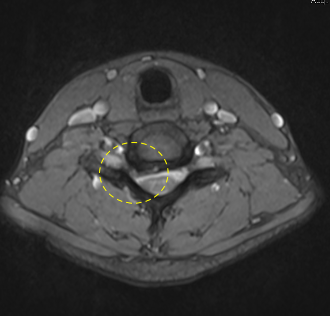 TDekkersPhysio's tweet photo. ‼️Do NOT perform cervical manipulation if your patient has a scan like this‼️👇

This patient was being manipulated/adjusted every 2 weeks for months for neck pain....

The scan shows a large C6/7 disc protrusion with severe right foraminal stenosis. There is a lesser disc protrusion also at C5/6.

For the record Ive done extensive manual therapy training, including manips, and support its use in the right patient, at the right time. So this is not an anti-manual therapy post.

However, a contra-indication to cervical manips/high velocity thrusts/adjustments should be any radicular arm symptoms, which this patient had. The scan explains the symptoms clearly.

🤷‍♀️ If you use use these techniques, really question why and when....Patient safety should be our number 1 concern.

I have seen worsening of radicular symptoms, with sometimes severe results from cervical (and occasionally lumbar) manipulation.

Thankfully this patient has not had any deleteiorus effects - however I have told them to avoid ANY future manipulations from now on.

There are many available treatments and techniques for spinal pain, and for someone with a scan like this, manipulation should not be one of them. End of. 🫷🚫