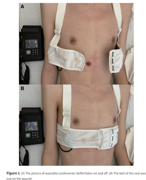 European Society of Cardiology Journals (@esc_journals) on Twitter photo An unusual complication from a wearable cardioverter defibrillator ow.ly/vEnZ50VSngM
#EHJCaseReports <a href="/Phiso_de/">Philipp Sommer</a> <a href="/TJ_Yeo/">Tee Joo YEO</a> <a href="/aayshacader/">Aaysha Cader</a> <a href="/BoldiKovacsMD/">Boldizsar Kovacs</a> <a href="/KardiologieHH/">Erik Rafflenbeul</a> <a href="/ANazmiCalik/">A.Nazmi Calik</a> <a href="/O_Azizy_MD/">Obayda Azizy</a> <a href="/saramoscatelli7/">Sara Moscatelli</a> <a href="/EHJCREiC/">EHJCaseReports Editor-in-Chief</a> #CardioX #EPeeps An unusual complication from a wearable cardioverter defibrillator ow.ly/vEnZ50VSngM
#EHJCaseReports <a href="/Phiso_de/">Philipp Sommer</a> <a href="/TJ_Yeo/">Tee Joo YEO</a> <a href="/aayshacader/">Aaysha Cader</a> <a href="/BoldiKovacsMD/">Boldizsar Kovacs</a> <a href="/KardiologieHH/">Erik Rafflenbeul</a> <a href="/ANazmiCalik/">A.Nazmi Calik</a> <a href="/O_Azizy_MD/">Obayda Azizy</a> <a href="/saramoscatelli7/">Sara Moscatelli</a> <a href="/EHJCREiC/">EHJCaseReports Editor-in-Chief</a> #CardioX #EPeeps