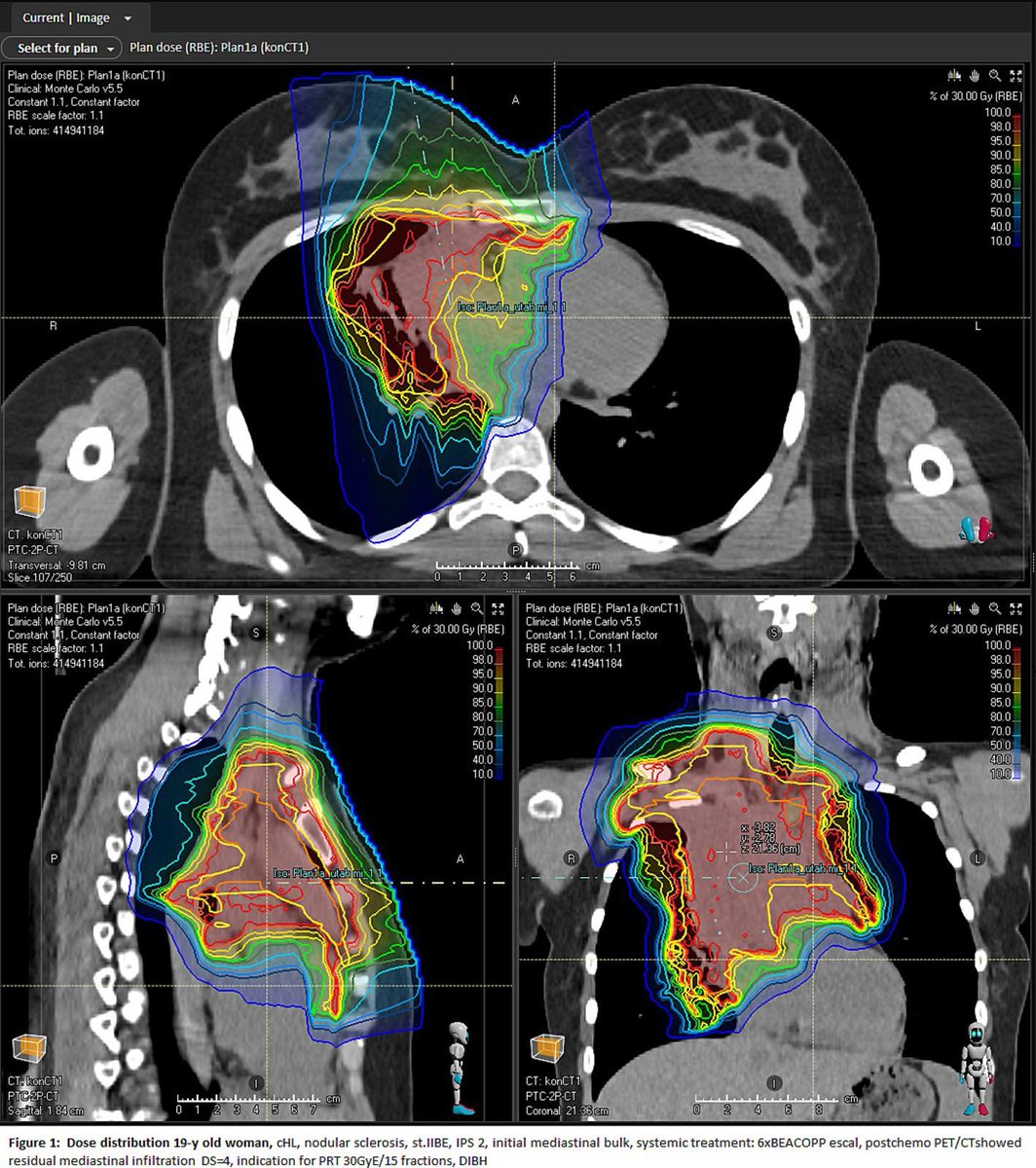 vit_prochazka's tweet image. Proud to share 🇨🇿Hodgkin Study Group study on Proton 🌟beam therapy ⚛️
➡️ 163 pts, with organs-at-risk dose limits or cardiovascular/pulmonary comorbidities.
➡️ outstanding long term efficacy, very limited “collateral damage”
➡️bit.ly/3FhmIRQ
@geltamo