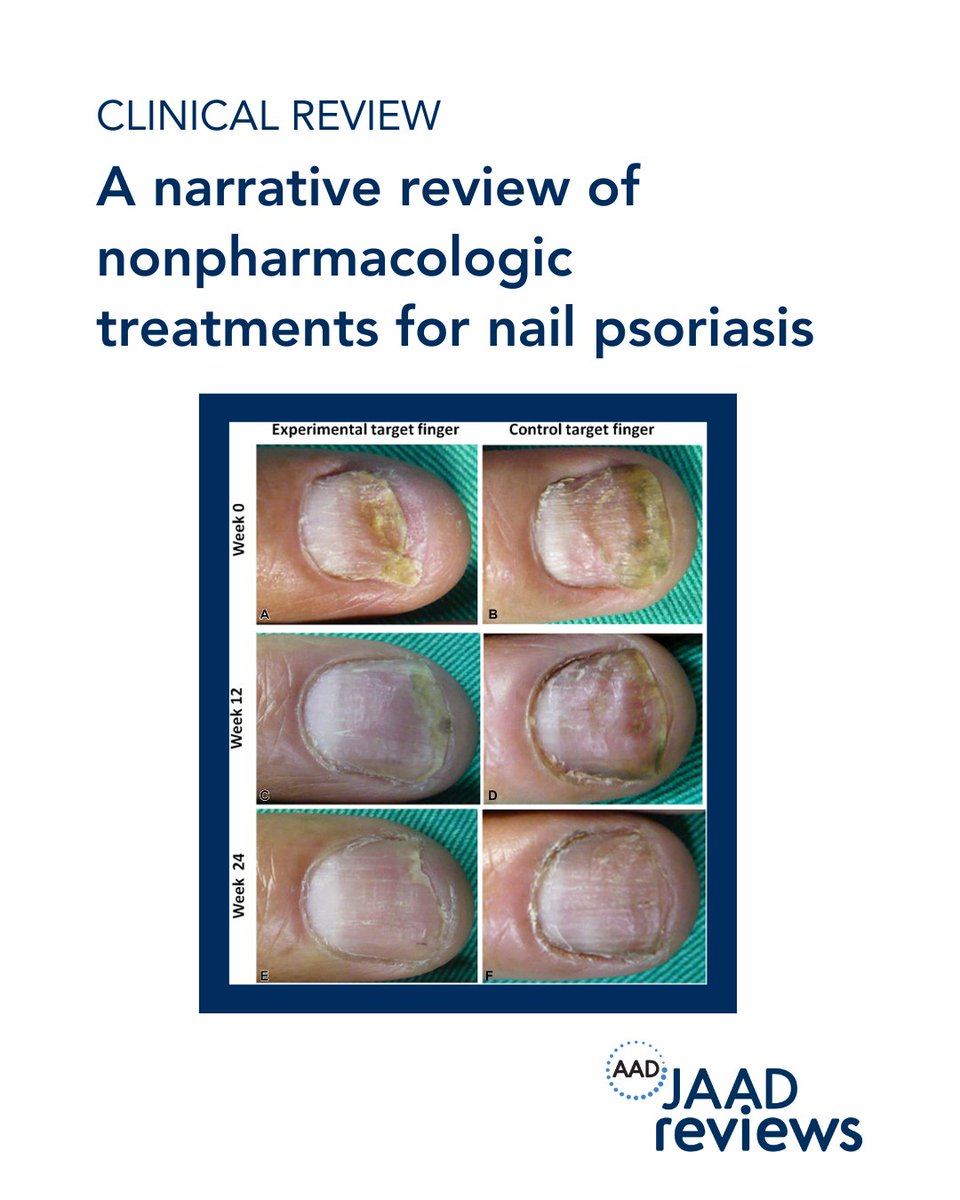 A large majority of people with plaque psoriasis (80-90%) or psoriatic arthritis (80%) also have nail psoriasis. New research looks at natural treatments like oral omega-3s, vitamins, indigo naturalis and diet. Learn more in JAAD Reviews: bit.ly/3EZLuWL