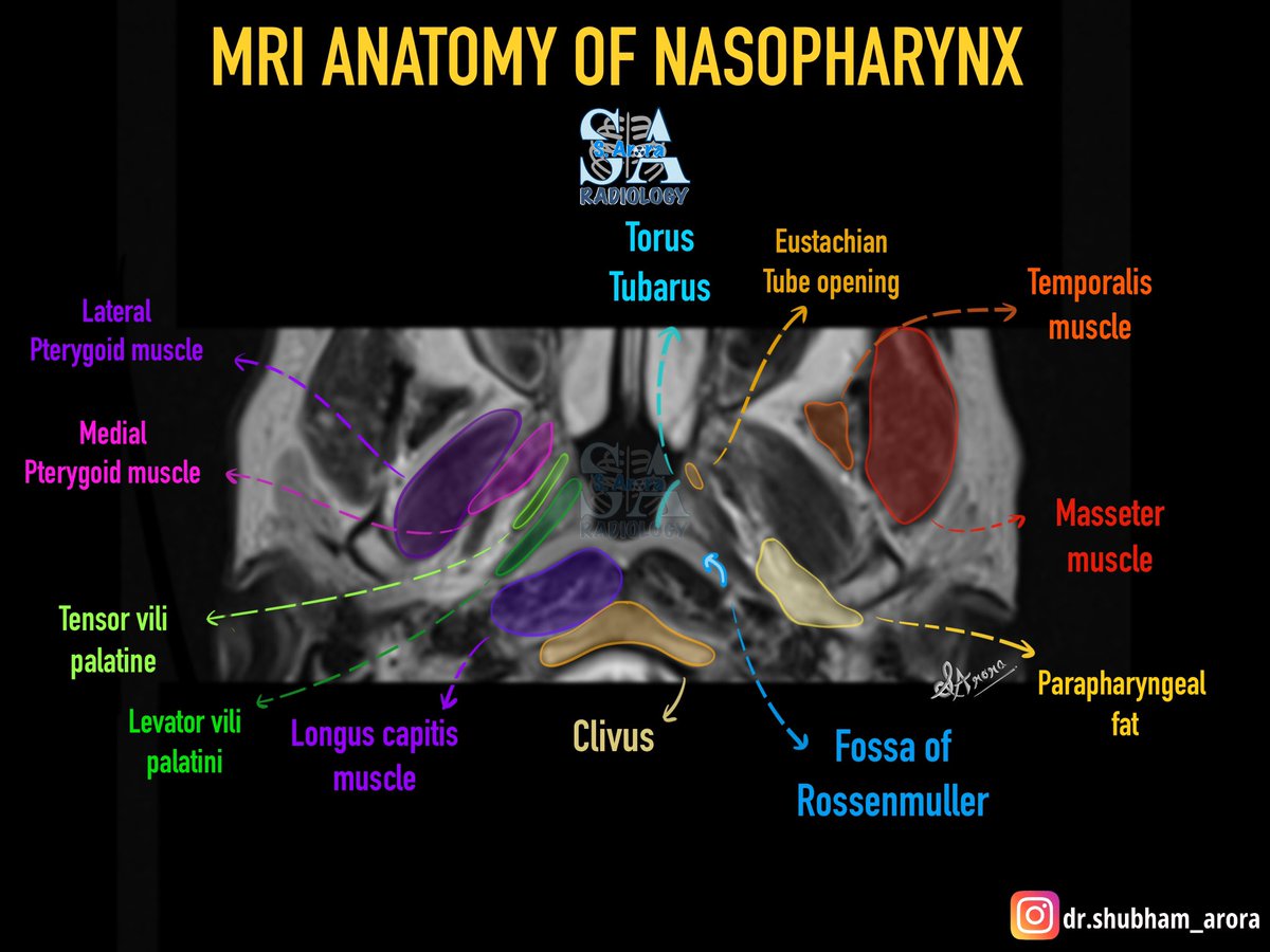 Dr_S_Arora's tweet image. Slide on MRI anatomy of nasopharynx.
#medX #Radiology