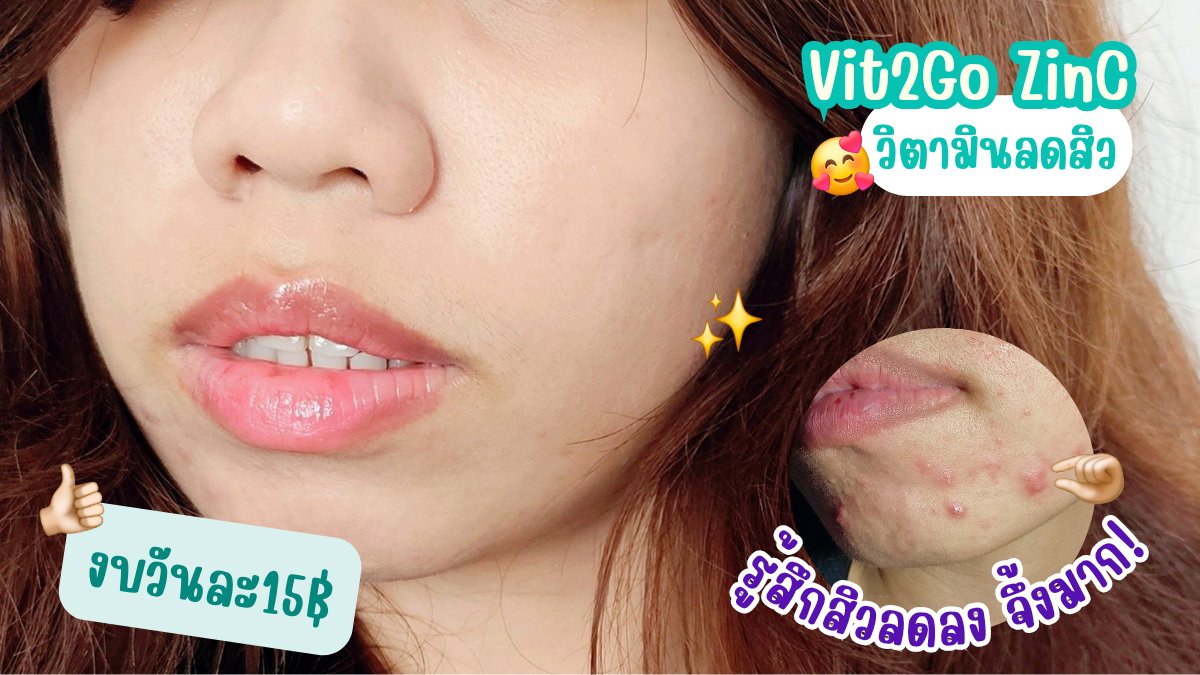 minechaechae's tweet photo. ไอเทมใหม่ ลดสิวราคานักเรียน #Vit2GoZinC ✨️ มี 2 สูตร #Vit2GoHeyboy สำหรับผู้ชาย👦🏻 ช่วยลดฮอร์โมนเพศชายที่เกินระดับให้สมดุล แถมลดสิวฮอร์โมนด้วย และ #Vit2goHeyGirl สำหรับผู้หญิง 👧🏻 ดูแลฮอร์โมนเพศหญิง ไม่ให้อารมณ์สวิง ทั้งสองสูตร มี zinc ช่วยลดสิว, Niacinamide ปรับสีผิวสม่ำเสมอ และ วิตามิน A และ E 💞 เพียงซองละ 15฿ ทานหลังอาหารแค่วันละ1ซองเท่านั้น~
#Vit2Go #Vit2GoวิตามินลดสิวสูตรGenZ #Handyherb