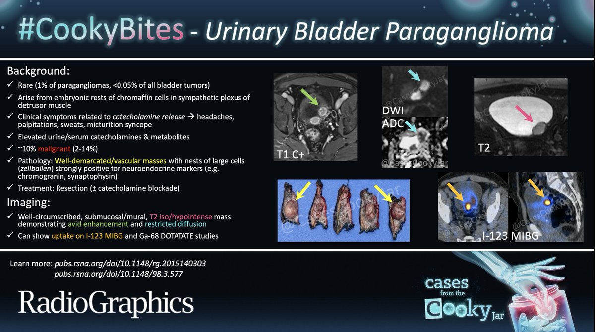 Cases From the Cooky Jar (@casescookyjar) on Twitter photo Answer: Urinary Bladder Paraganglioma
Learn more:
pubs.rsna.org/doi/10.1148/rg…
pubs.rsna.org/doi/10.1148/98…
#CookyBites #216 #RGphx <a href="/cookyscan1/">Cooky Menias</a> <a href="/RadioGraphics/">RadioGraphics</a> Answer: Urinary Bladder Paraganglioma
Learn more:
pubs.rsna.org/doi/10.1148/rg…
pubs.rsna.org/doi/10.1148/98…
#CookyBites #216 #RGphx <a href="/cookyscan1/">Cooky Menias</a> <a href="/RadioGraphics/">RadioGraphics</a>