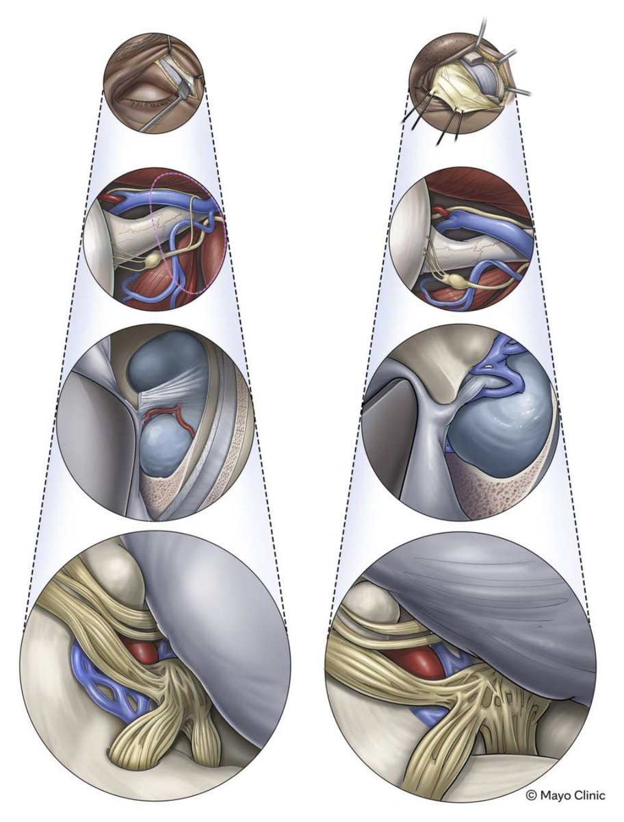 Mayo Clinic ENT (@mayoclinicent) on Twitter photo How do lateral transorbital and orbital wall approaches compare in access and outcomes for orbital and middle cranial fossa lesions?
Click to read more: bit.ly/45gfkkb
#MayoClinicENTResearch #MedTwitter <a href="/fabionchunipa/">Fabio Torregrossa MD, PhDs</a> #CesareZoia #DanieleBongetta <a href="/mmjbauman/">Megan Bauman (Graves), MD</a> How do lateral transorbital and orbital wall approaches compare in access and outcomes for orbital and middle cranial fossa lesions?
Click to read more: bit.ly/45gfkkb
#MayoClinicENTResearch #MedTwitter <a href="/fabionchunipa/">Fabio Torregrossa MD, PhDs</a> #CesareZoia #DanieleBongetta <a href="/mmjbauman/">Megan Bauman (Graves), MD</a>