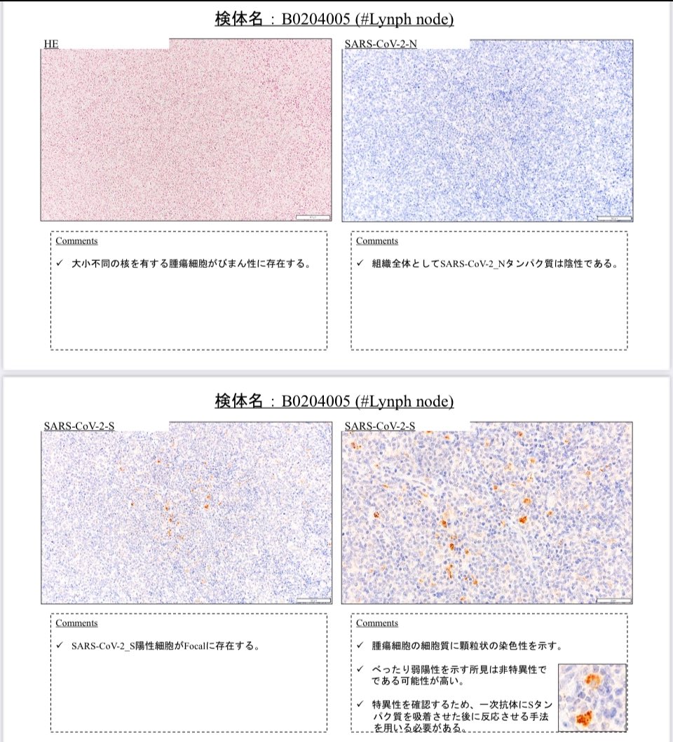 kharaguchi's tweet photo. これが私のがん細胞を分析したものです。悪性リンパ腫が扁桃腺に転移していましたが切除して研究機関に回した病変です。
　コロナワクチン接種後、2年も経過していたのにスパイク蛋白が悪政リンパ腫から見つかりました。
　他方、N蛋白は見つかりません。つまり私はコロナには感染していなかったということです。

　コロナワクチンの引き起こす悲劇を一刻も早く止めなければなりません。

私のこのデータは、更に詳細な分析を行い論文になる予定です。

＠liz_churchill10 
＠kharaguchi 
＠RobertKennedyJc 

---

This is an analysis of my cancer cells. It was determined that the malignant lymphoma had metastasized to the tonsils, but the lesions were removed and sent to a research facility. 

Even two years after receiving the COVID-19 vaccine, spike proteins were found in the malignant lymphoma. Conversely, N proteins were not detected. This indicates that I had not been infected with COVID-19.

We must put an end to the tragedies caused by the COVID-19 vaccine as soon as possible.

This data is planned to undergo further detailed analysis and will be used for a research paper.