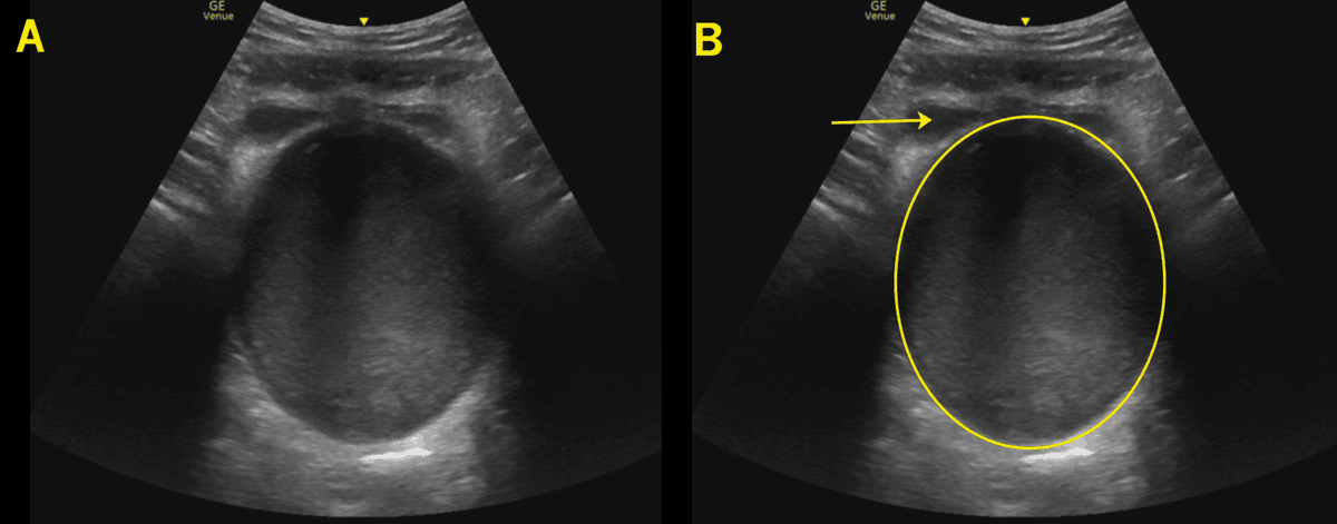 jminardi21's tweet photo. You can guess in pediatric patients with abdominal pain or you can get more definitive answers in seconds, avoiding diagnostic error, diagnostic delay, and improving outcomes #POCUS #PEMPOCUS 
https://t.co/LMUXN0bxKe https://t.co/7EnbrSaNIh