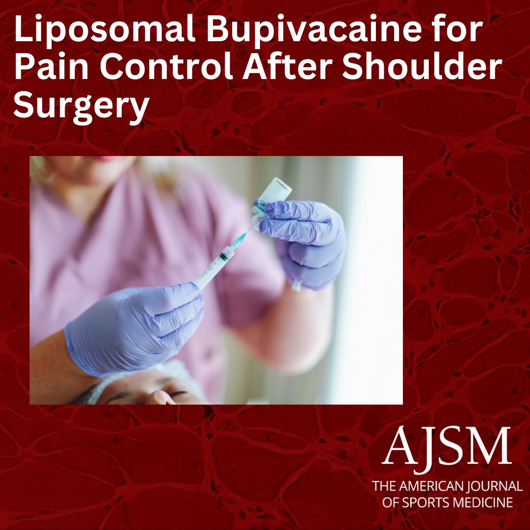 aossmjournals's tweet image. Discover how liposomal bupivacaine is revolutionizing postoperative pain management in shoulder surgery. This study, recently published in AJSM, explores its efficacy and potential benefits. 

ow.ly/RuK450VUrF4

 #ShoulderSurgery #OrthopedicSurgery