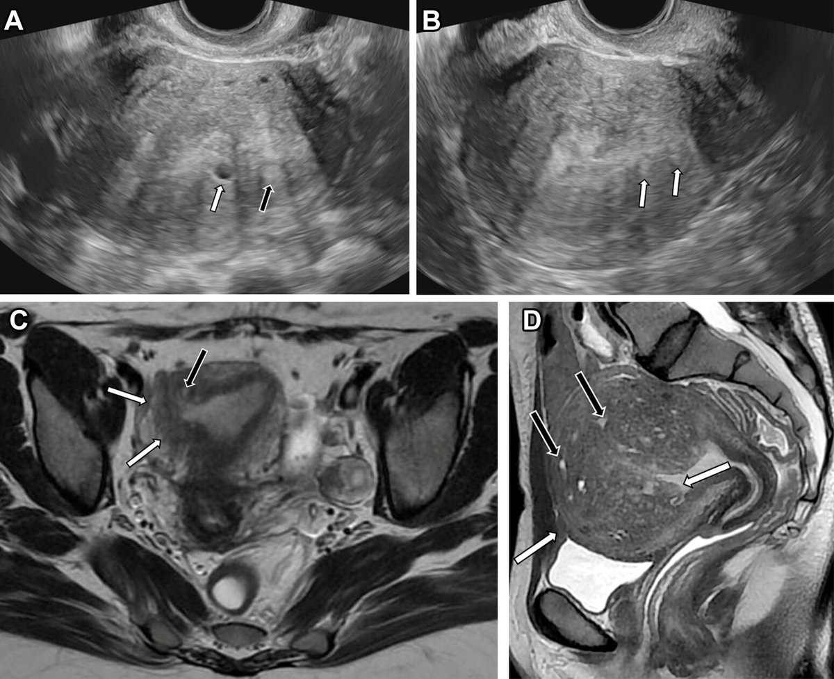 RadioGraphics (@radiographics) on Twitter photo Adenomyosis is a benign condition characterized by ectopic endometrial glands and stroma within the myometrium. Learn about the typical and atypical imaging features, along with key differential considerations. <a href="/lucianachamiec1/">luciana@chamie.com.br</a> <a href="/OliveiraDe4890/">Brunna de Oliveira</a> bit.ly/43kmLEI Adenomyosis is a benign condition characterized by ectopic endometrial glands and stroma within the myometrium. Learn about the typical and atypical imaging features, along with key differential considerations. <a href="/lucianachamiec1/">luciana@chamie.com.br</a> <a href="/OliveiraDe4890/">Brunna de Oliveira</a> bit.ly/43kmLEI