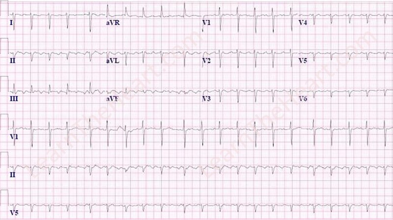 LearntheHeart's tweet photo. #ECGoftheWeek #Cardiology https://t.co/DTdeVY7ZTr