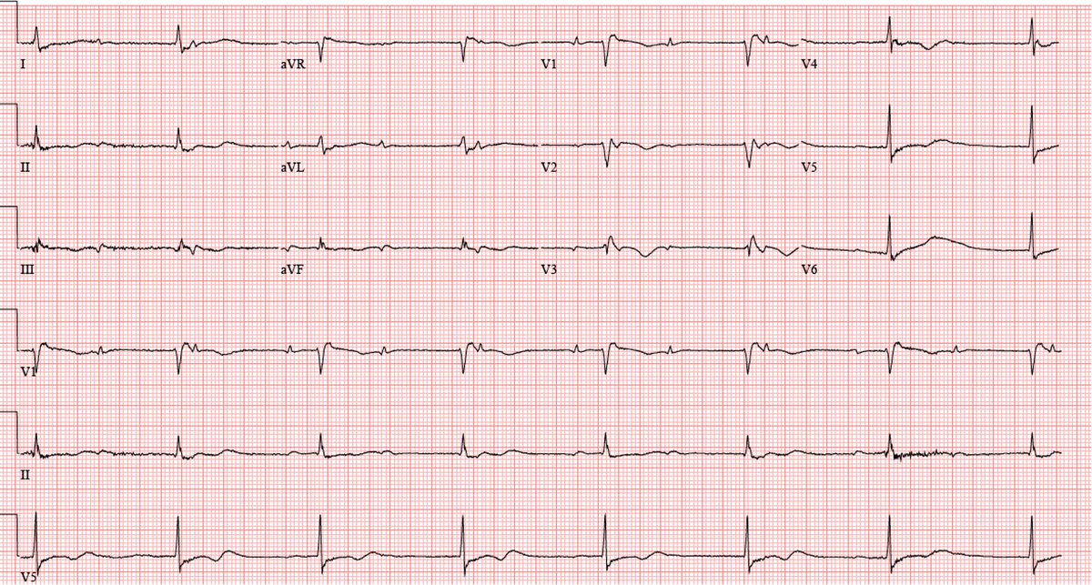 UC San Diego Cardiology Fellows (@ucsdcardfellows) on Twitter photo Presenting a new #UCSDCardiologyCases!
A 53M w/ HTN & HLD presented to ED w/ bradycardia. Initial ECG showed complete heart block (CHB)! CXR: cardiomegaly. Echo: severe LVH, dilated RV, WMA. What’s on your ddx? 1/6
🤔 #CardioTwitter #MedTwitter <a href="/UCSDCardiology/">UC San Diego Cardiology</a> Presenting a new #UCSDCardiologyCases!
A 53M w/ HTN & HLD presented to ED w/ bradycardia. Initial ECG showed complete heart block (CHB)! CXR: cardiomegaly. Echo: severe LVH, dilated RV, WMA. What’s on your ddx? 1/6
🤔 #CardioTwitter #MedTwitter <a href="/UCSDCardiology/">UC San Diego Cardiology</a>