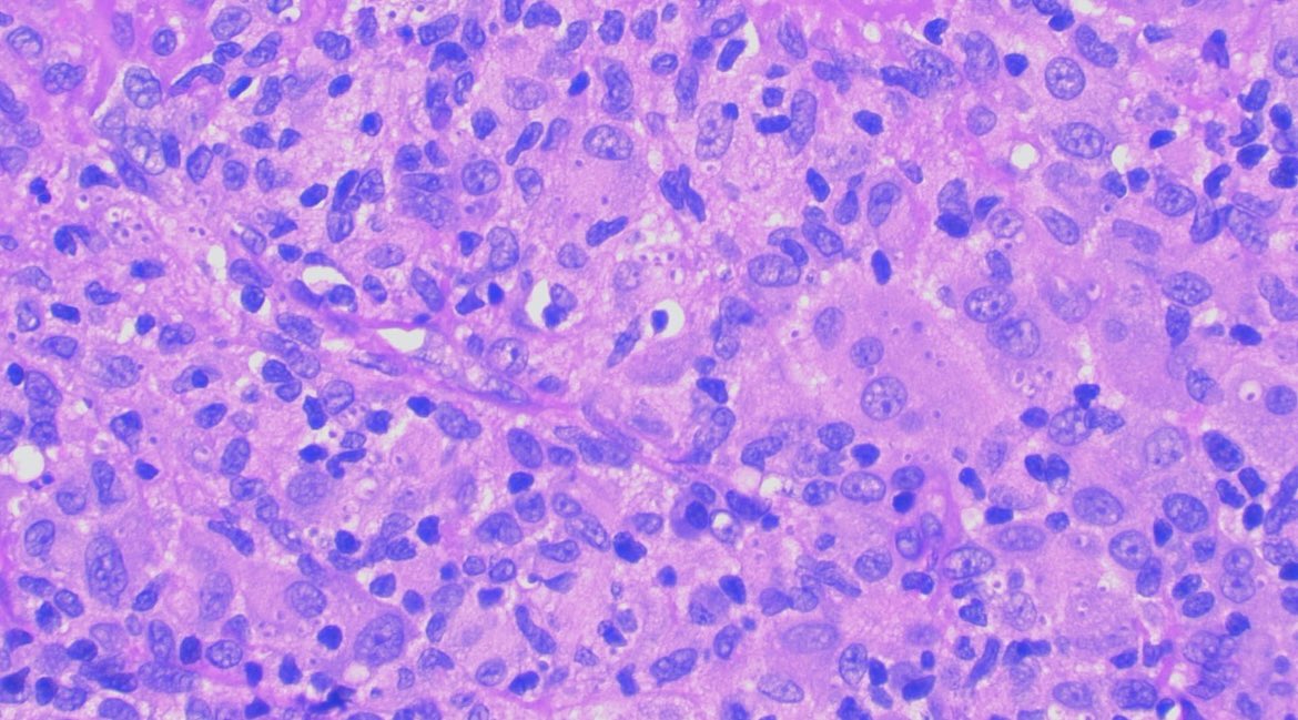 JCandidoXavier's tweet photo. #oral lesion
SCC?
HISTOPLASMOSIS
Yeast inside macrophages as a dot surrounded by a halo
Silver+ to exclude #leish
Small round yeasts joined like a grape 🍇
Multinucleate giant cells can be present
#oralpath #pathology #fungi #dermpath https://t.co/5XmpuU4TOZ