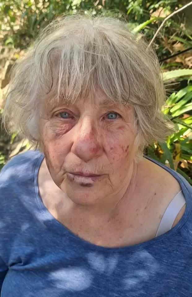 RiseAgainstEvil's tweet photo. FARM ASSAULT: Mbombela pensioner brutally hacked with panga, beaten and left unconscious.
A brutal assault on a husband and wife on a farm in the Uitkyk area has left the community in shock.A 73-year-old pensioner narrowly escaped with his life after a brutal attack that left him with severe head trauma.

Jan Jurgens (73) and his wife, Antoinette (72), live on a farm along the Uitkyk Road. On Monday, May 12, at around 18:45, Jan was in a storeroom fetching animal feed when at least two robbers attacked him.Among other injuries, he was hacked with a panga and repeatedly struck in the face and on the head with a rock.

His farm dogs rushed to defend him, but the attackers turned on them as well, slashing at them with the panga.

One of the dogs, a Labrador, suffered deep lacerations and is still being treated at a local veterinarian clinic.“The assault was so severe that my father lost consciousness,” his son, Jannie, told Lowvelder.

The robbers tied Jan’s hands and feet with shoelaces.

“Every time he regained consciousness, they would either kick him or jump on him,” 
 
A brutal assault on a husband and wife on a farm in the Uitkyk area has left the community in shock.
May 16, 2025  Buks Viljoen  2 minutes read

 Photos: Supplied.
A 73-year-old pensioner narrowly escaped with his life after a brutal attack that left him with severe head trauma.

Jan Jurgens (73) and his wife, Antoinette (72), live on a farm along the Uitkyk Road. On Monday, May 12, at around 18:45, Jan was in a storeroom fetching animal feed when at least two robbers attacked him.

Among other injuries, he was hacked with a panga and repeatedly struck in the face and on the head with a rock.

His farm dogs rushed to defend him, but the attackers turned on them as well, slashing at them with the panga.

One of the dogs, a Labrador, suffered deep lacerations and is still being treated at a local veterinarian clinic.

“The assault was so severe that my father lost consciousness,” his son, Jannie, told Lowvelder.

The robbers tied Jan’s hands and feet with shoelaces.

“Every time he regained consciousness, they would either kick him or jump on him,” Jannie said.

Antoinette was not at home at the time.

Antoinette Jurgens.
“When Mum arrived home at around 19:00, the two men attacked her as well. However, she fought them off and managed to lock herself in the house,” Jannie explained.

She called for help and staff living on the farm rushed to her aid. The assailants fled the scene on foot.

When the first responders, including Theo Laas and his reaction officers of ACS Spartan Security, arrived at the farm, they initially could not locate Jan. He was later found unconscious in the storeroom.

“He was severely injured and struggling to breathe due to the trauma to his face. One of the residents of Renosterkop valley rushed him to a hospital,” Jannie said.