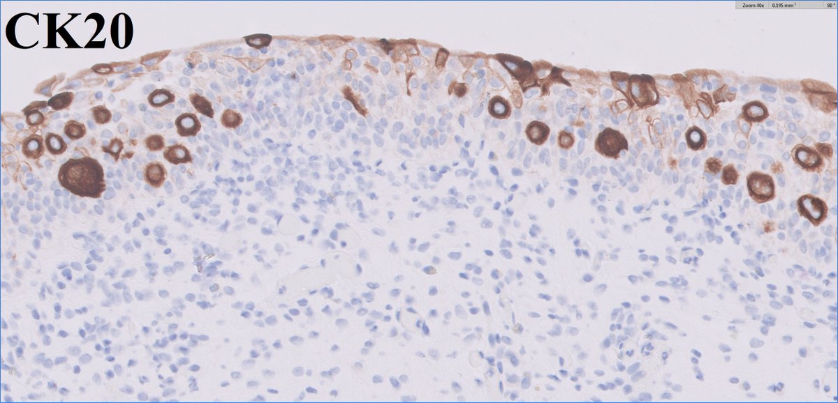 ▶️pagetoid/cancerization pattern urothelial carcinoma in situ (CIS)