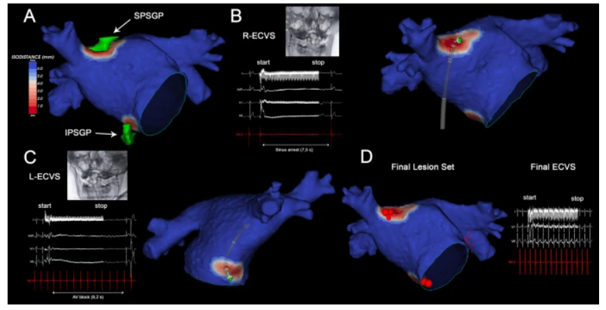 JICE (@jice_ep) on Twitter photo 🚨New #FreeRead in <a href="/JICE_EP/">JICE</a>
Computed Tomography-Based Ganglionated Plexi Identification and Bilateral Extra-Cardiac Vagal Stimulation for Streamline Cardioneuroablation Procedures
🧐📖 rdcu.be/emHFr
by Emanuele Curti, <a href="/DrFalasconi/">Giulio Falasconi, MD</a>, <a href="/Davidsotoiglesi/">David soto-iglesias</a>, Paula 🚨New #FreeRead in <a href="/JICE_EP/">JICE</a>
Computed Tomography-Based Ganglionated Plexi Identification and Bilateral Extra-Cardiac Vagal Stimulation for Streamline Cardioneuroablation Procedures
🧐📖 rdcu.be/emHFr
by Emanuele Curti, <a href="/DrFalasconi/">Giulio Falasconi, MD</a>, <a href="/Davidsotoiglesi/">David soto-iglesias</a>, Paula