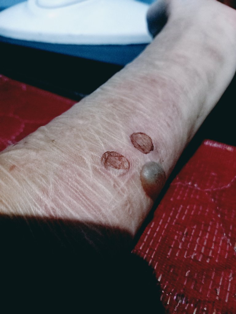 us23l63ss's tweet photo. cig burn | tw⚠️ https://t.co/xNo59gHgIY
