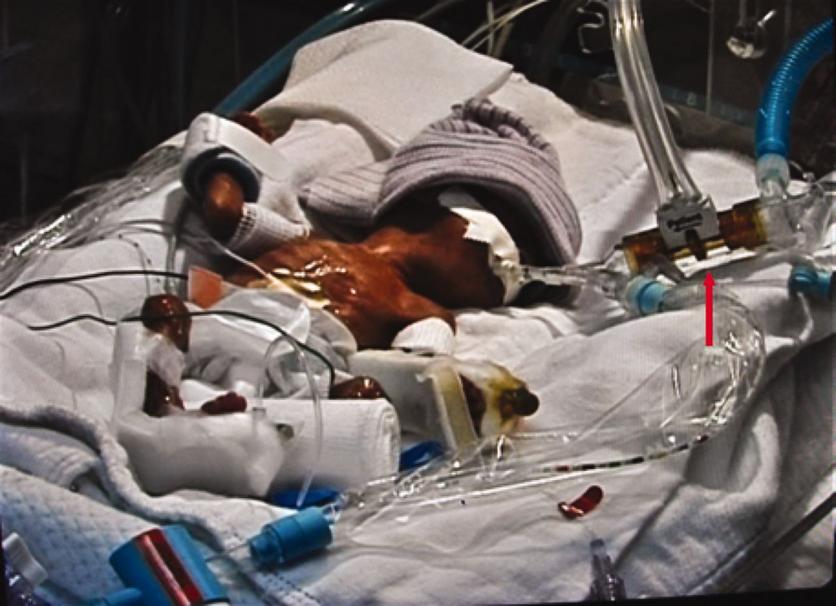 I just published "Nothing challenges a mother’s mental health like a high risk pregnancy." medium.com/p/nothing-chal…  #highriskpregnancy #firstpregnancy #neonatology