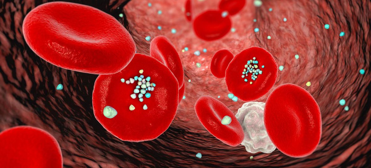 Heart Disease Deaths Worldwide Linked to Chemical Widely Used in Plastics. The study’s focus was a chemical to which exposure has been shown to prompt inflammation in the heart’s arteries.  Link to press release: nyulangone.org/news/heart-dis…