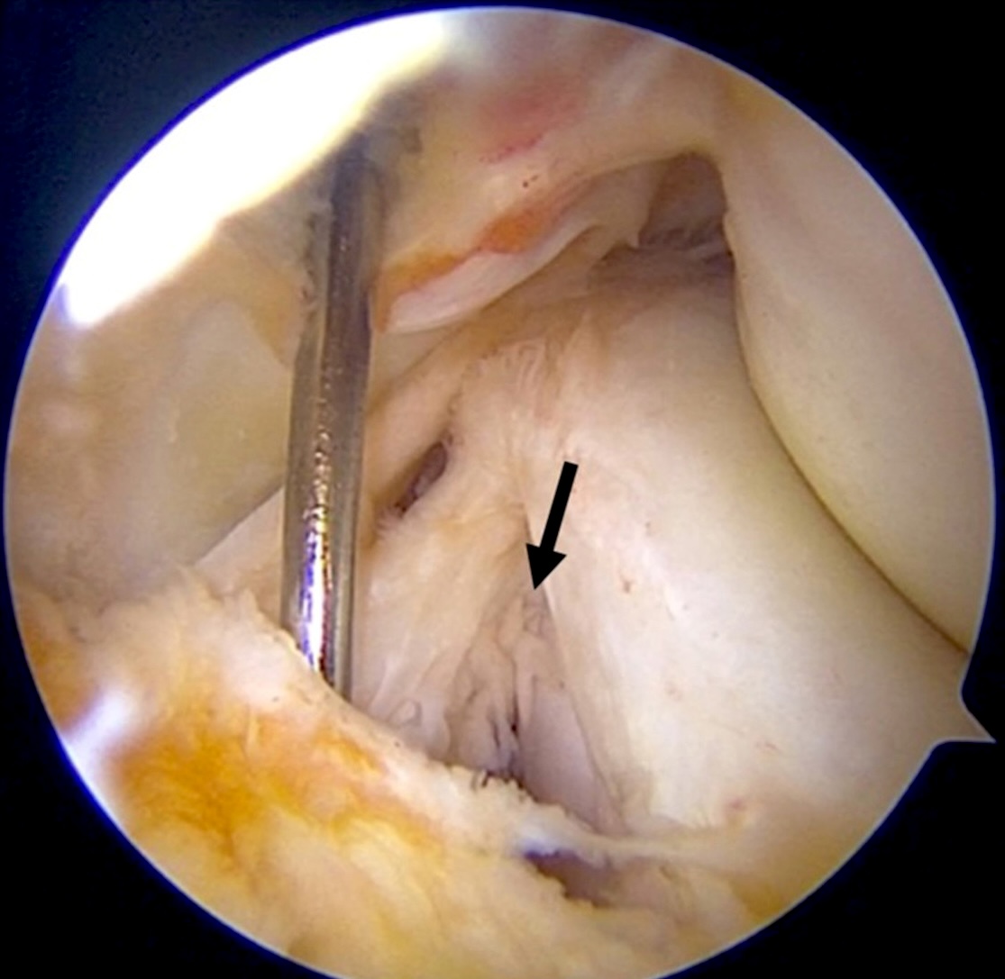 Chris Servant (@chrisservant65) on Twitter photo A few thoughts on medial meniscal ramp tears <a href="/ArthroscopyJ/">Arthroscopy Journal</a> #meniscus
kwnsfk27.r.eu-west-1.awstrack.me/L0/https:%2F%2… A few thoughts on medial meniscal ramp tears <a href="/ArthroscopyJ/">Arthroscopy Journal</a> #meniscus
kwnsfk27.r.eu-west-1.awstrack.me/L0/https:%2F%2…