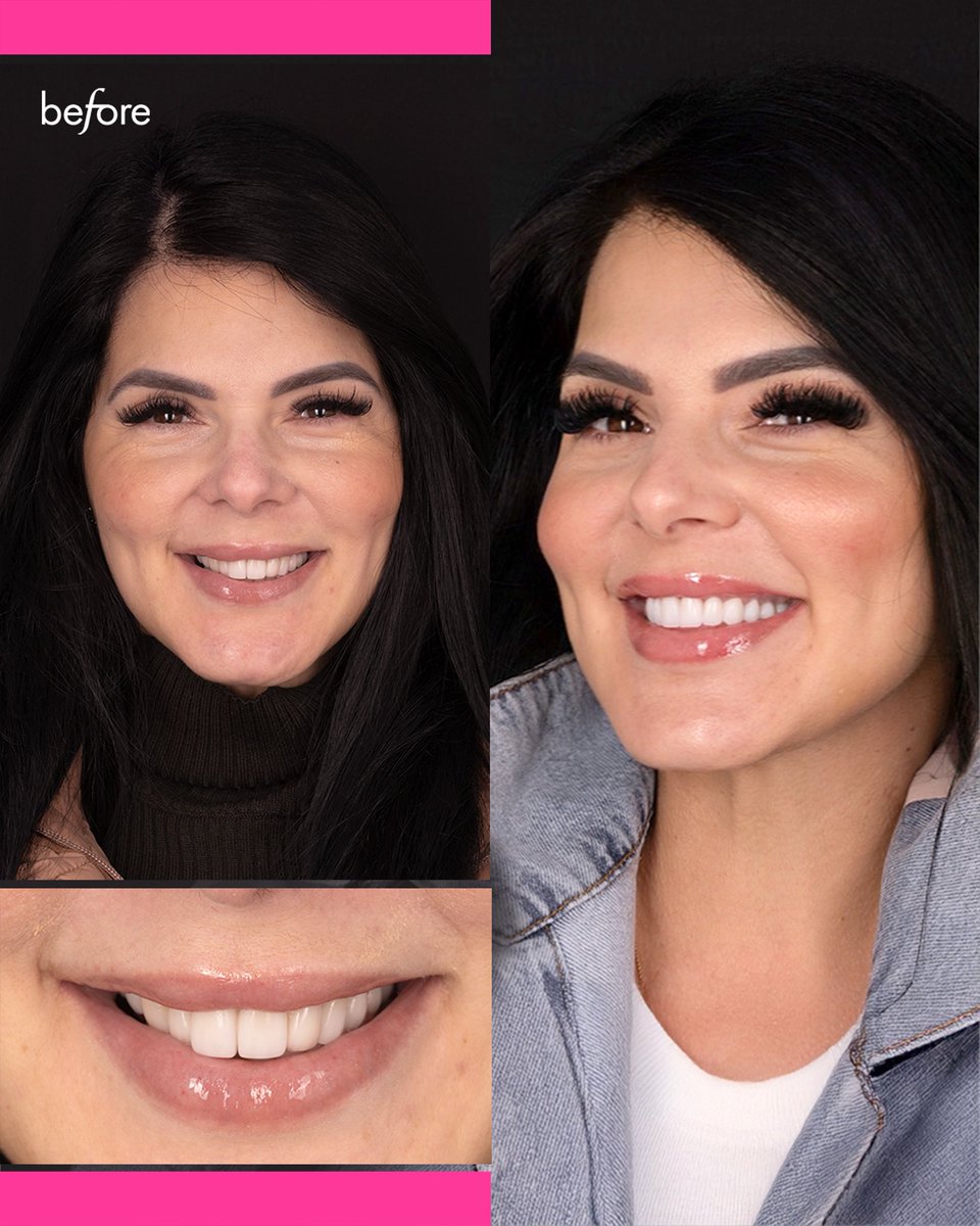 cgcsmile's tweet image. Tiny teeth upgrade, major confidence unlocked. These ceramic veneers? My new favorite superpower.
#SmileMagic #VeneerGlowUp #CGCutie