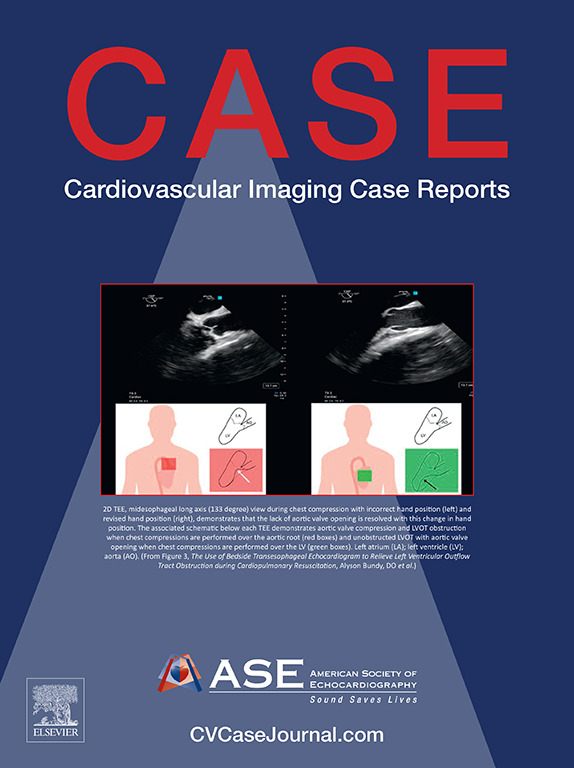American Society of Echocardiography (@ase360) on Twitter photo Our May 2025 <a href="/CASEfromASE/">CV Case Journal</a> is online! bit.ly/3EZ3nlI
This issue features:
🫀Right Ventricular Outflow Tract Obstruction and Pulmonary Hypertension
🫀Sonographer Insights on Clots in Transit—An Echo Case Series
🫀A Lesson in Left Ventricular Assist Device Physiology Our May 2025 <a href="/CASEfromASE/">CV Case Journal</a> is online! bit.ly/3EZ3nlI
This issue features:
🫀Right Ventricular Outflow Tract Obstruction and Pulmonary Hypertension
🫀Sonographer Insights on Clots in Transit—An Echo Case Series
🫀A Lesson in Left Ventricular Assist Device Physiology