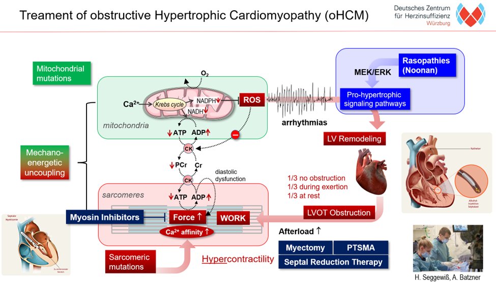 cardiomet_CE's tweet photo. 15b) #SRT⬇️O2 consumption ➡️⬆️mechanical efficiency of the #LV. This can now largely be achieved medically with cardiac myosin inhibitors #CMIs that stabilize the "superrelaxed state" #SRX of myosin. This SRX is not so well achieved in the pt with #oHCM. https://t.co/axTvkuT6Au
